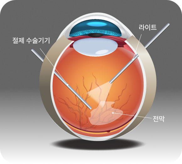 망막전막 제거술